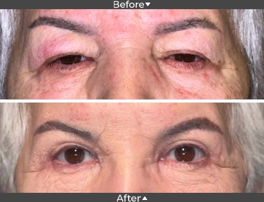 Ptosis for saggy eyes, Assil Gaur Eye Institute of Los Angels Ptosis for saggy eyes, Assil Gaur Eye Institute of Los Angels