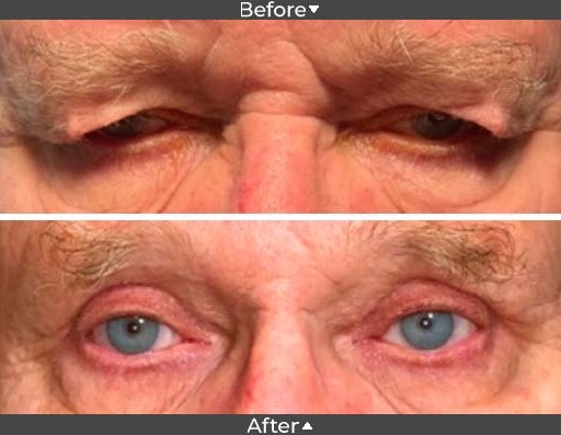 ptosis before and after pictures, Assil Gaur Eye Institute ptosis before and after pictures, Assil Gaur Eye Institute