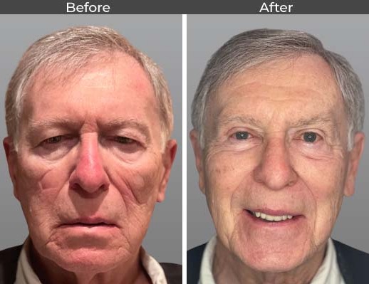 ptosis before and after images ptosis before and after images