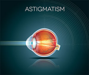 Astigmatism: causes, symptoms and treatments, Assil Gaur Eye Institute Los Angeles Astigmatism: causes, symptoms and treatments, Assil Gaur Eye Institute Los Angeles