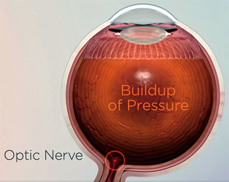 Eye pressure from Glaucoma, Assil Gaur Eye Institute of Los Angeles Eye pressure from Glaucoma, Assil Gaur Eye Institute of Los Angeles