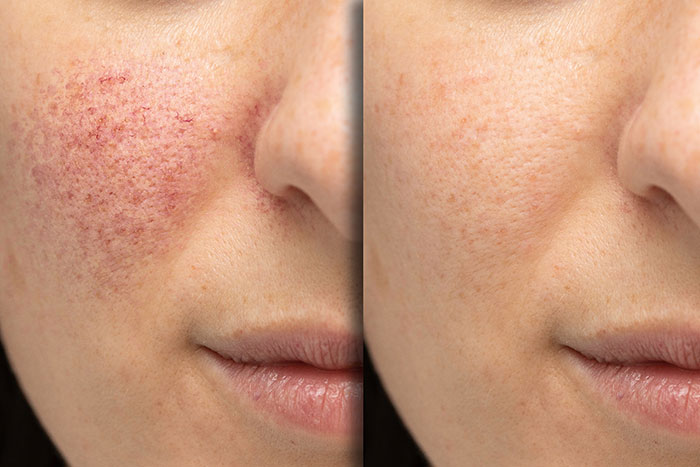 Photofacial before and after Photofacial before and after