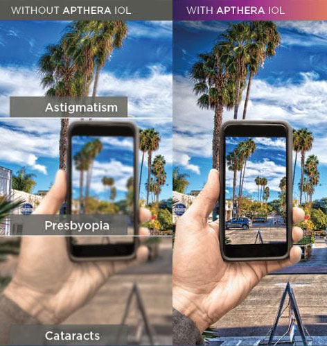 Apthera IOL Apthera IOL